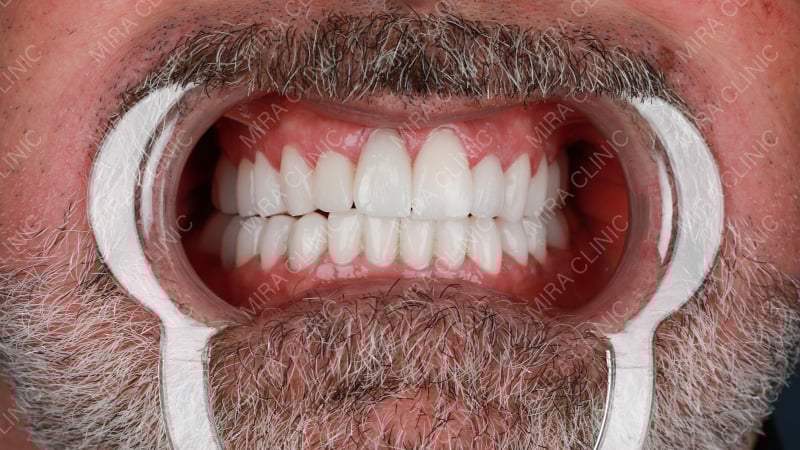 Dental Implants and Smile Restoration